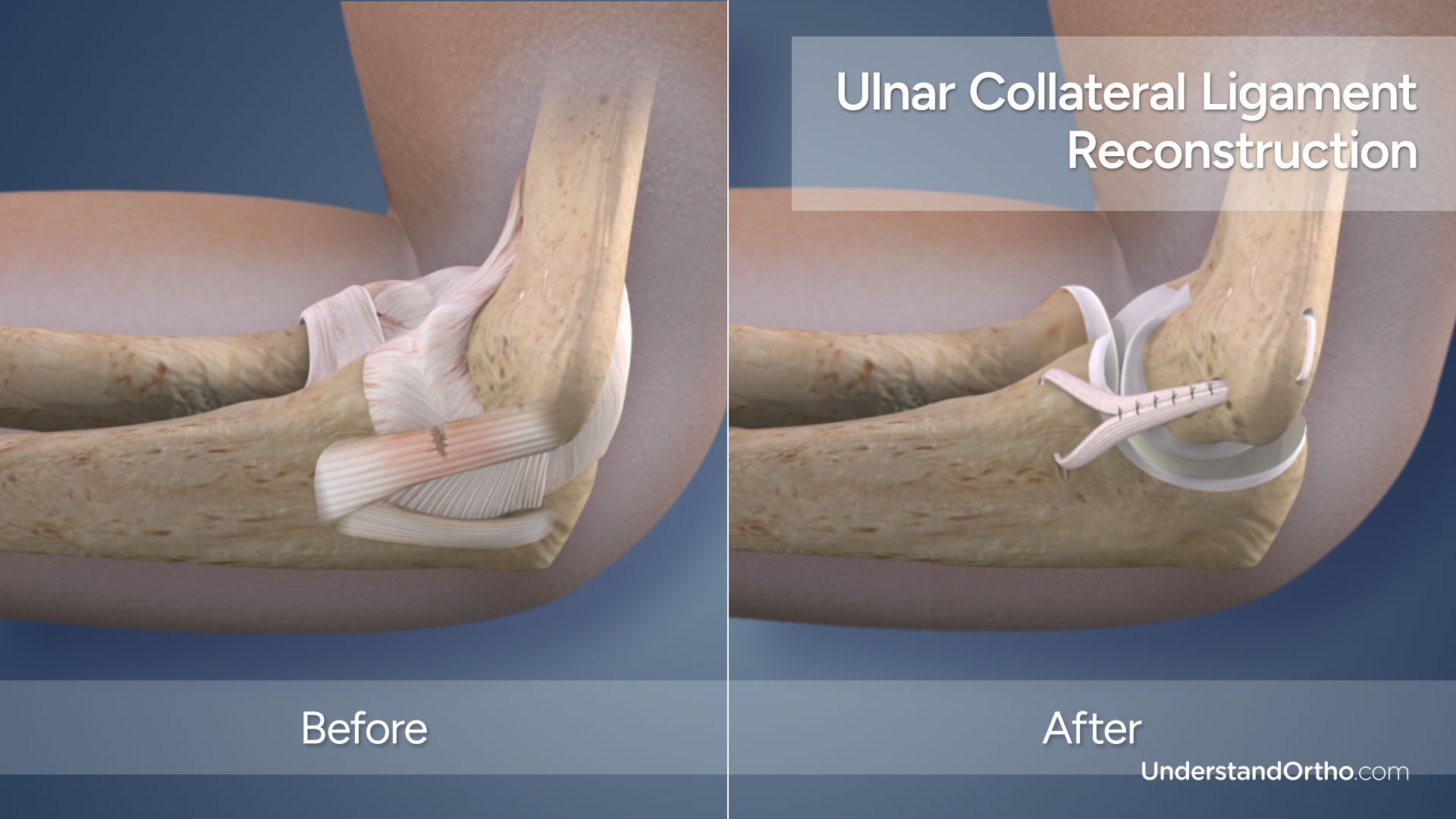 tommy john surgery before after